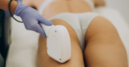 A Terapia com Laser é Eficaz no Tratamento de Estrias?