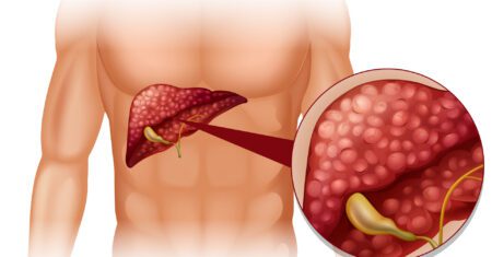 Gordura no Fígado – O Que é e Como Diminuir