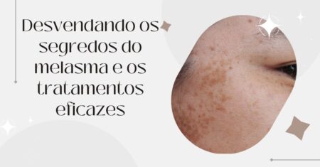 O Que É Melasma: Sintomas, Causas e Tratamentos Eficazes