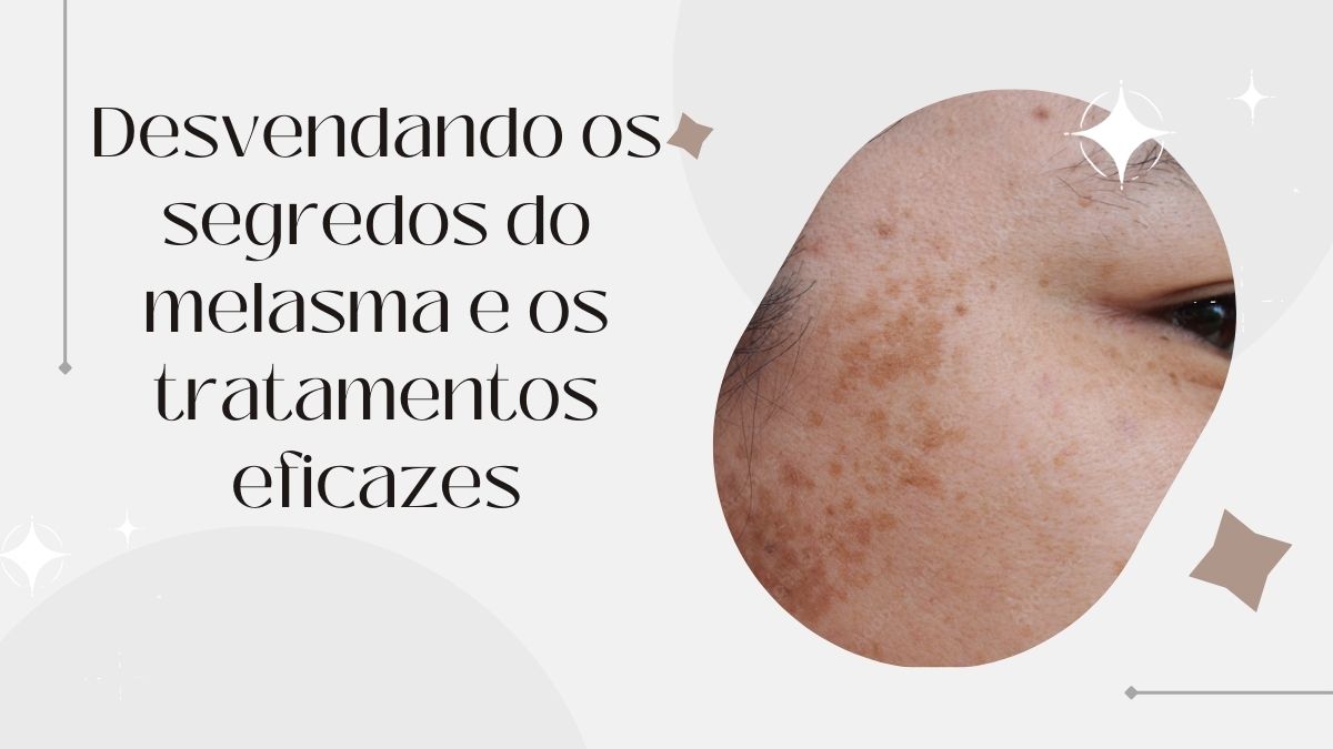 O Que É Melasma: Sintomas, Causas e Tratamentos Eficazes